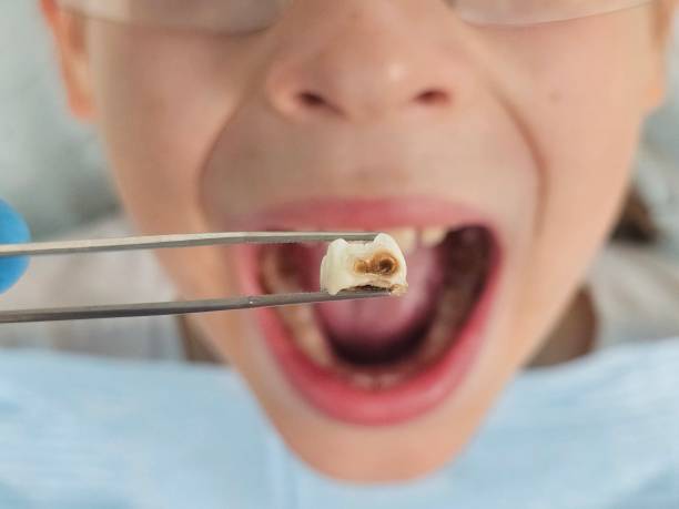 Best Emergency Tooth Extraction in Wylie, TX